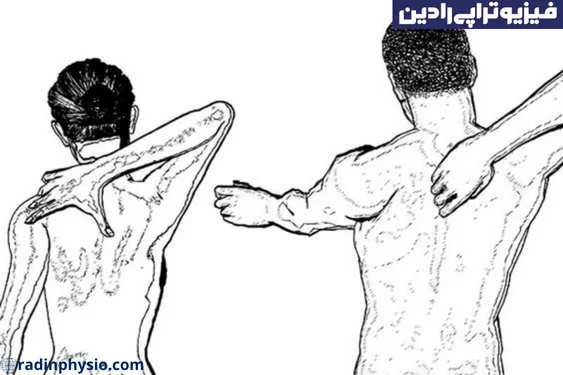 رادیکولوپاتی چیست؟ فیزیوتراپی رادیکولوپاتی