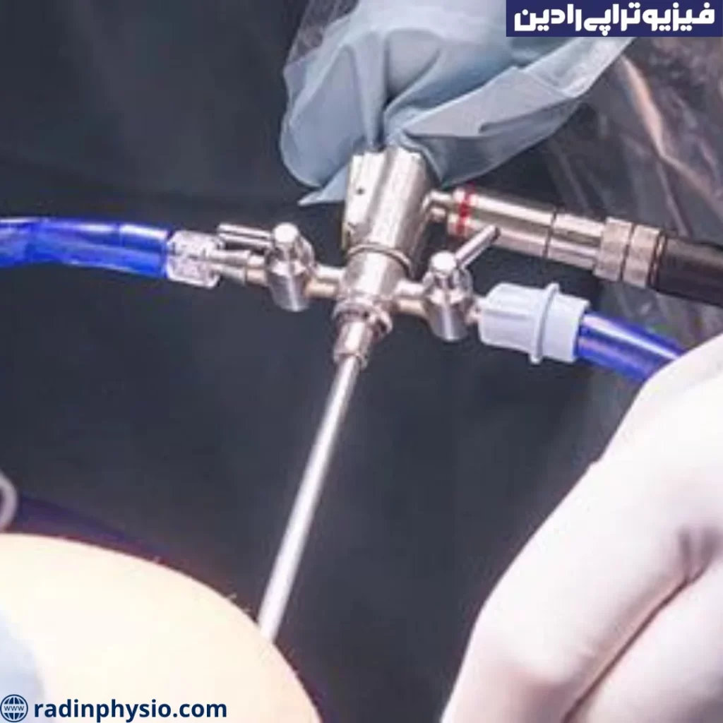 آرتروسکوپی مچ دست