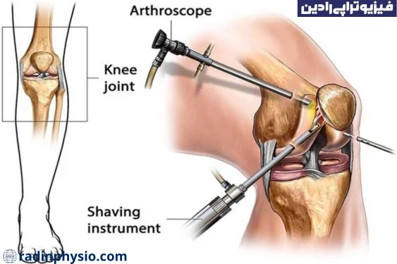 جراحی آرتروسکوپی