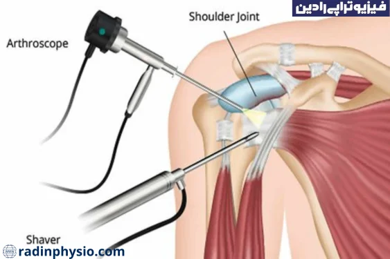 عمل جراحی آرتروسکوپی