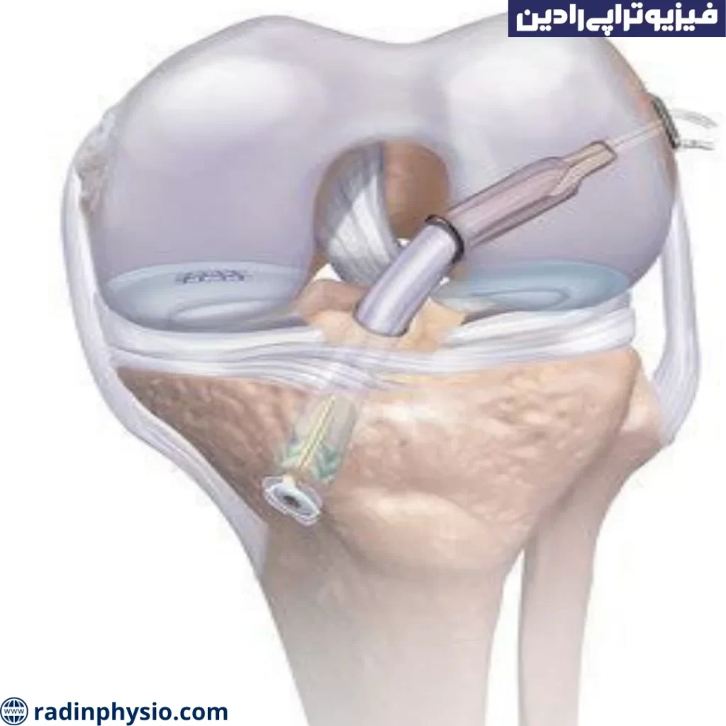 عمل آرتروسکوپی