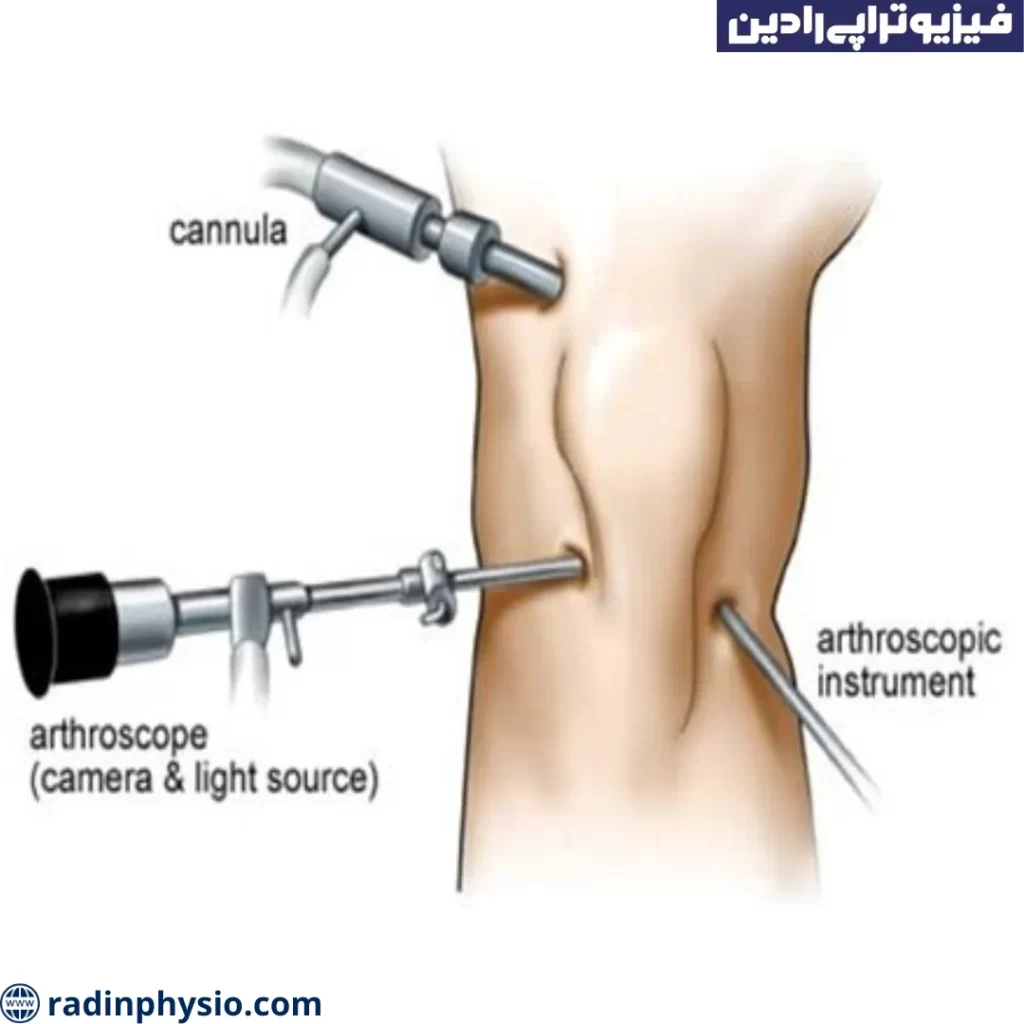 آرتروسکوپی مچ دست