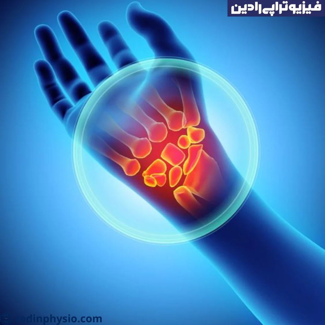 فیزیوتراپی سندروم تونل کارپال