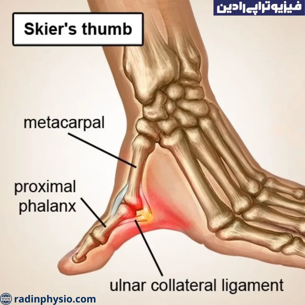 سندرم تونل کارپال