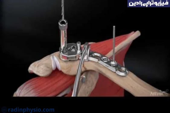علل شکستگی استخوان ترقوه