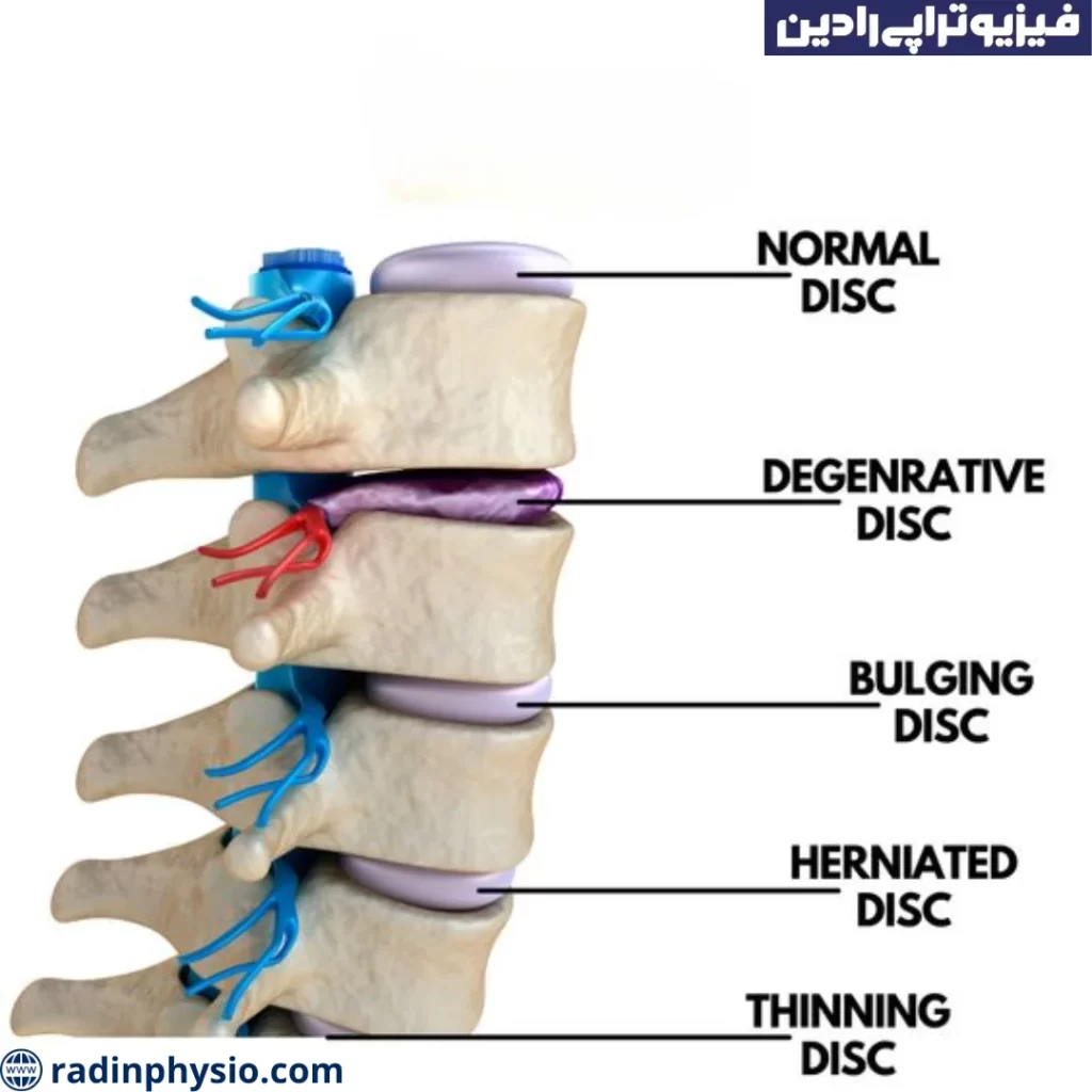جراحی دیسک کمر با بی حسی موضعی