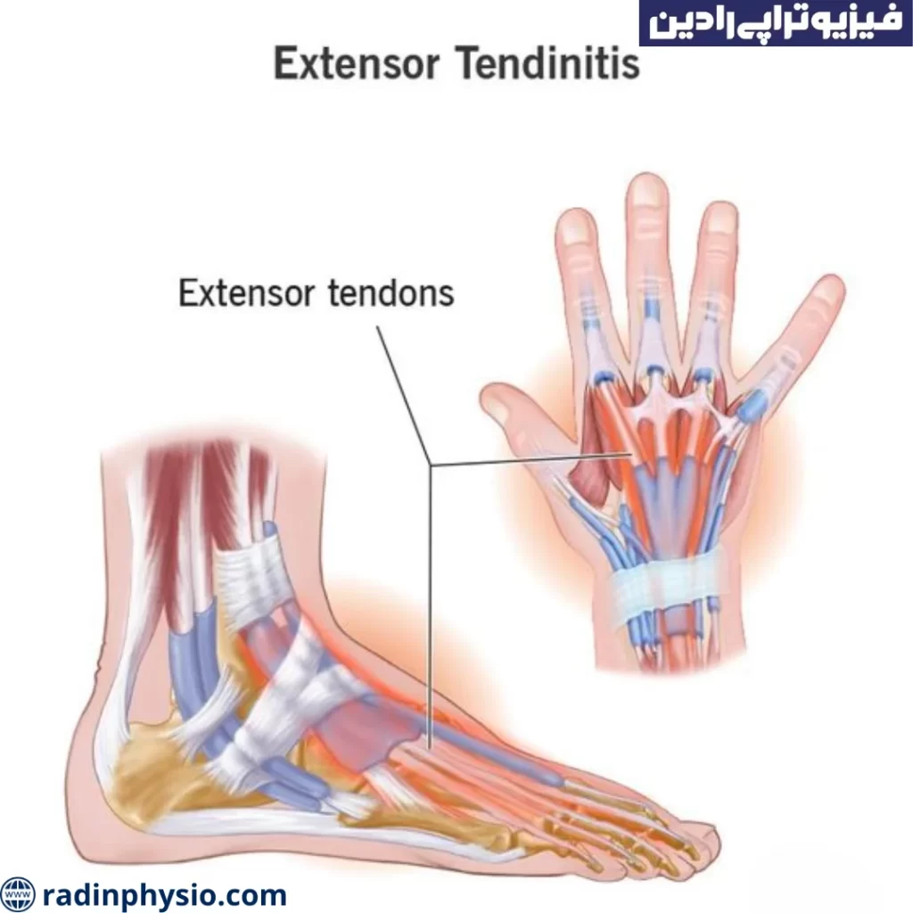 تاندونیت اکستانسور دست