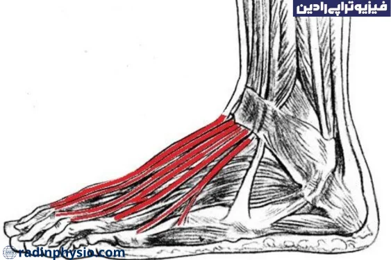 فیزیوتراپی تاندونیت اکستانسور