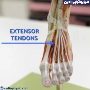 تاندونیت اکستانسور دست