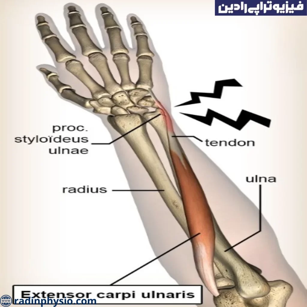 علت ابتلا به تاندونیت اکستانسور دست