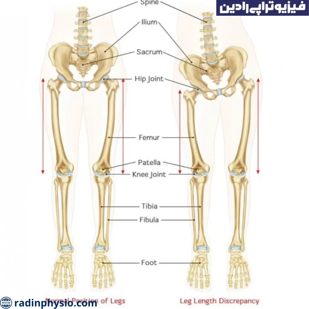 درمان کوتاهی پا با کایروپراکتیک