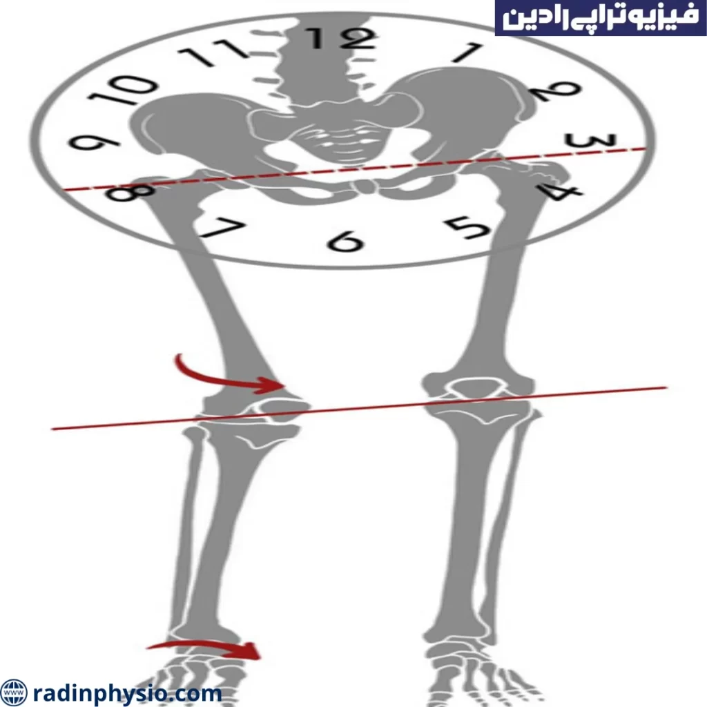 سندرم پای کوتاه