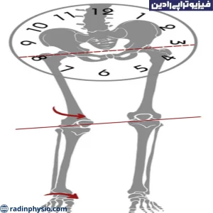 سندرم پای کوتاه