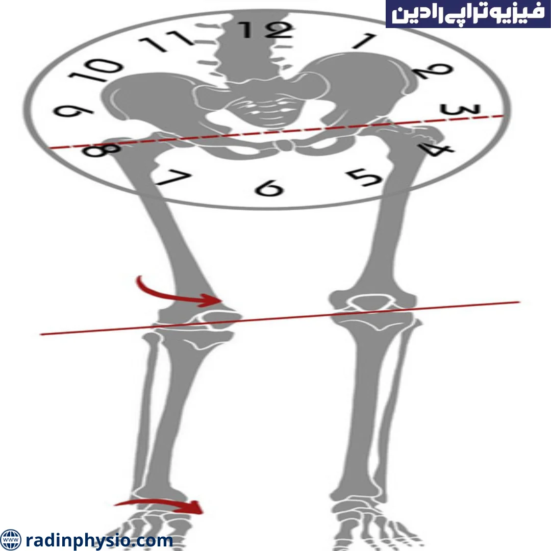 سندرم پای کوتاه