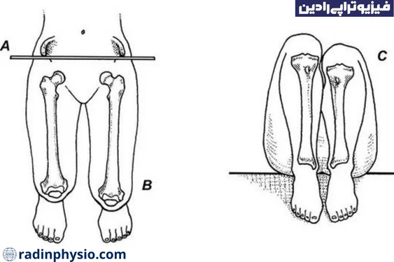علت اختلاف طول پا