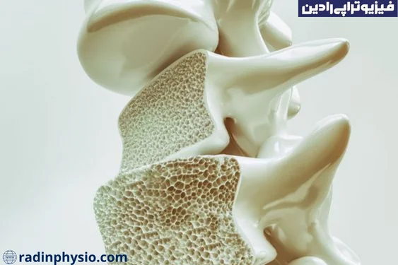پوکی استخوان در یائسگی