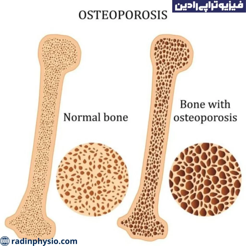 پوکی استخوان در یائسگی