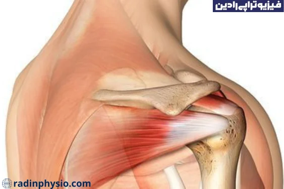 فیزیوتراپی پارگی روتاتور کاف شانه