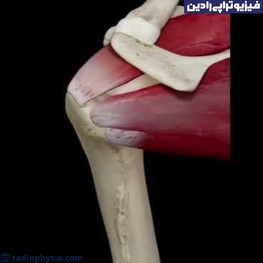 علل پارگی تاندون روتاتور