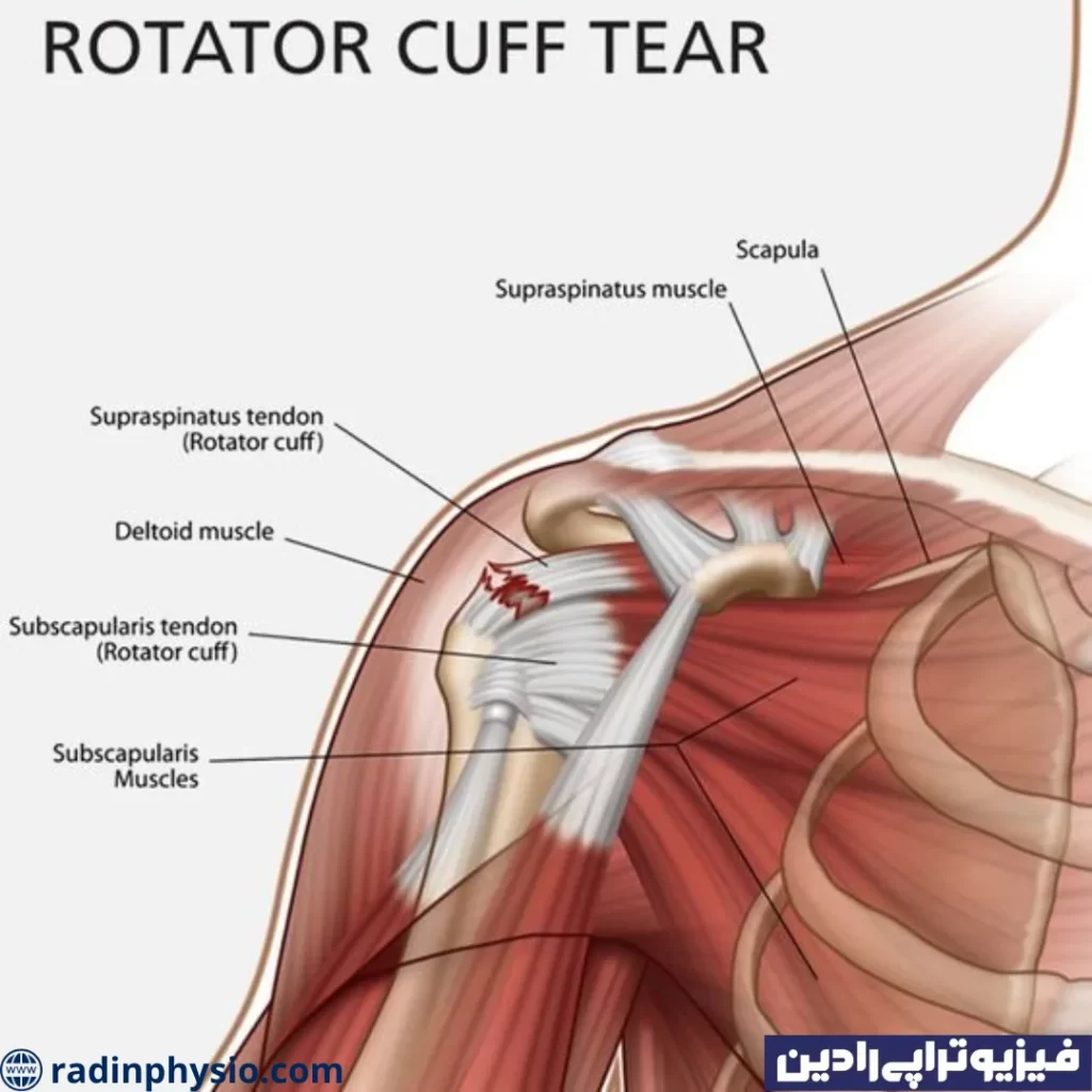 آسیب تاندون روتاتور