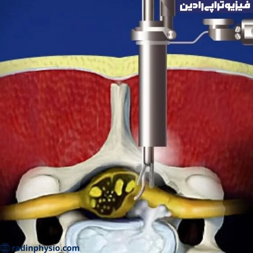 لامینکتومی (Laminectomy)