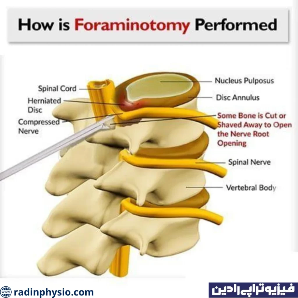 TLIF (Transforaminal Lumbar Interbody Fusion)