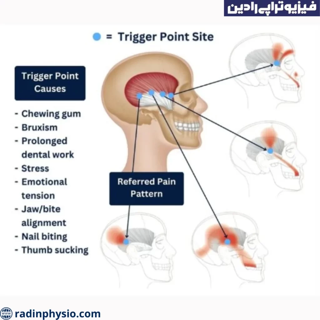 تریگر پوینت ها به چند دسته تقسیم می شوند