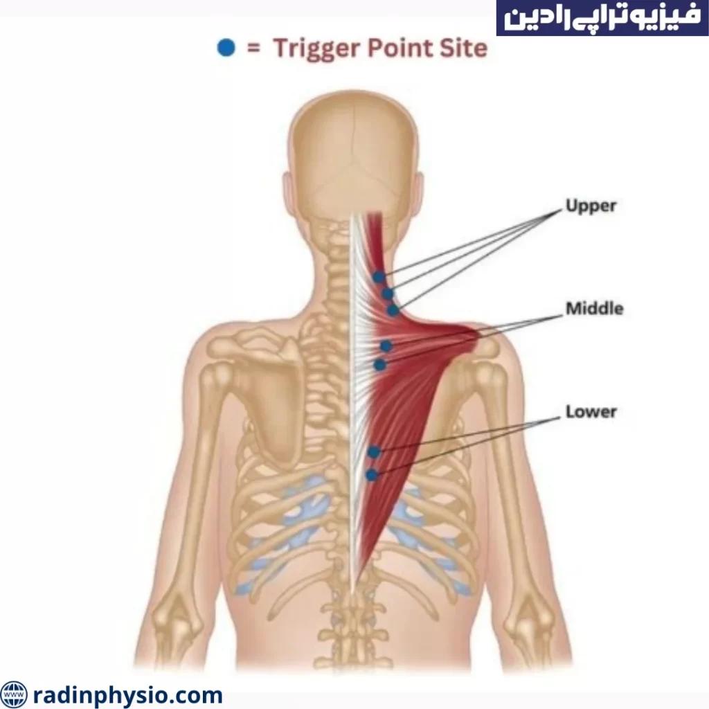 تریگر پوینت ها چگونه درمان می شوند