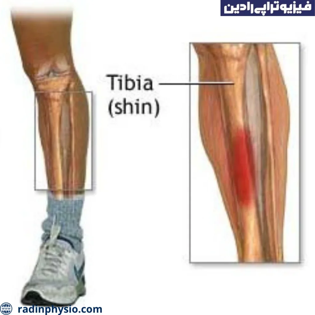 شکستگی شافت تیبیا