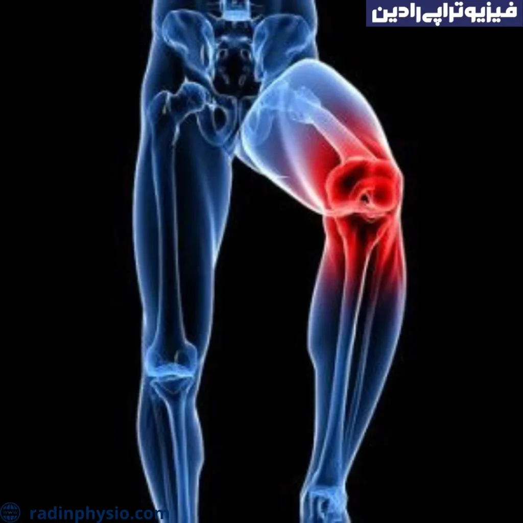 ورید واریس