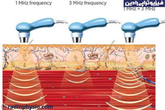 القای آلتراسوند تراپی شوکی