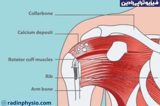 درمان رسوب کلسیوم شانه با تزریق کورتون