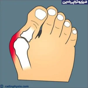 بیماری هالوکس والگوس