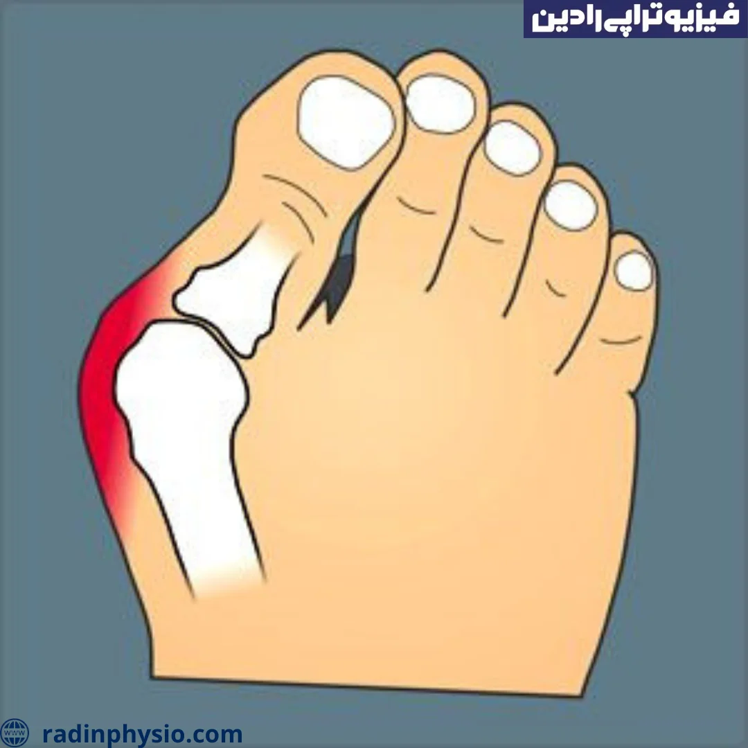 بیماری هالوکس والگوس