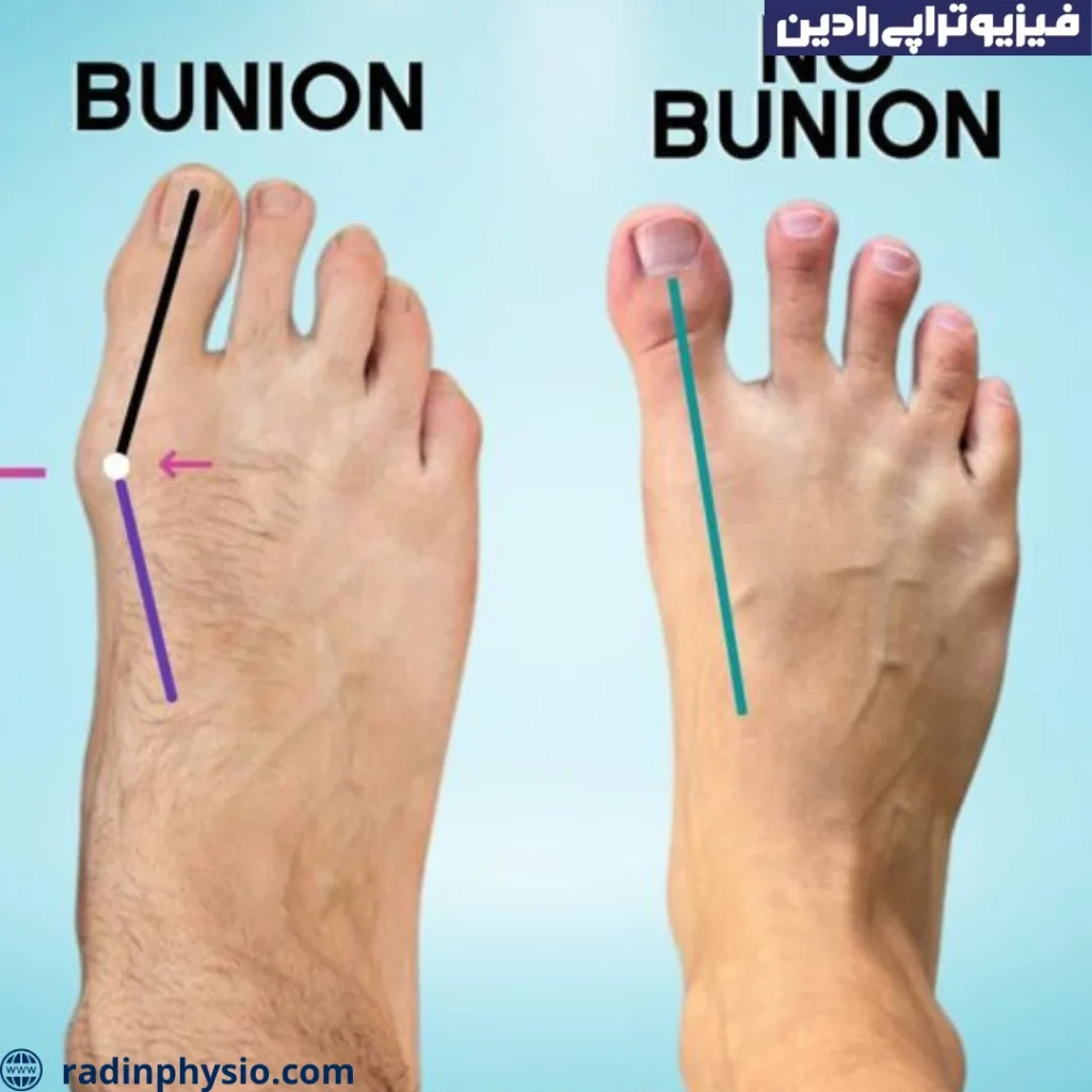 علائم انحراف شست پا