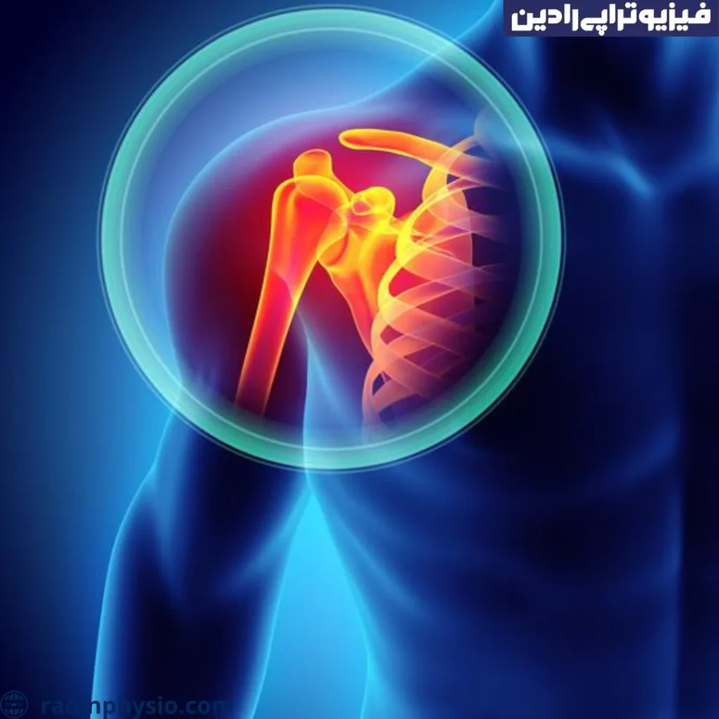 فیزیوتراپی شانه یخ زده