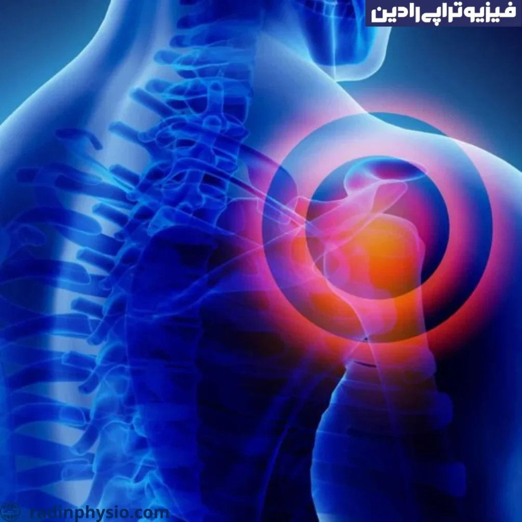 درمان شانه یخ زده