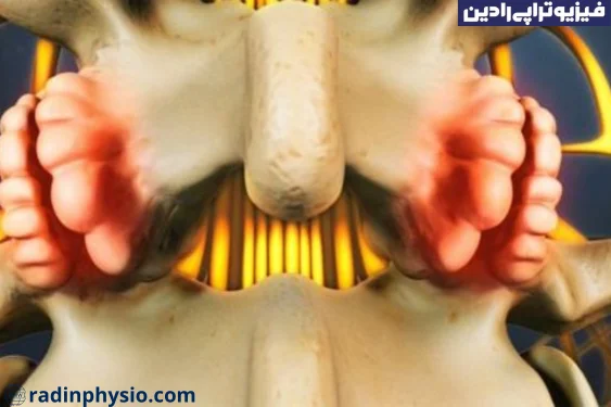 فیزیوتراپی خار استخوانی