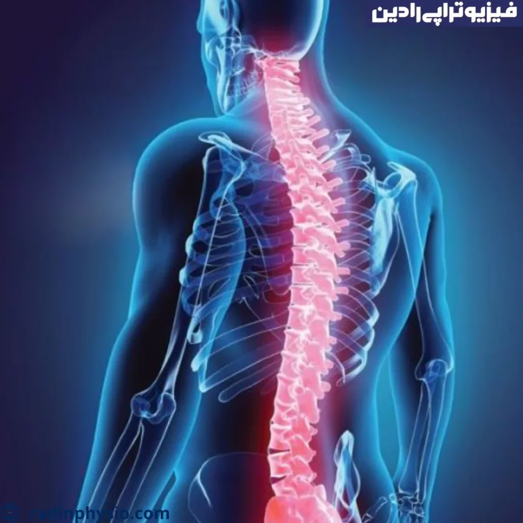 فیزیوتراپی سندروم مفصل فاست ستون فقرات