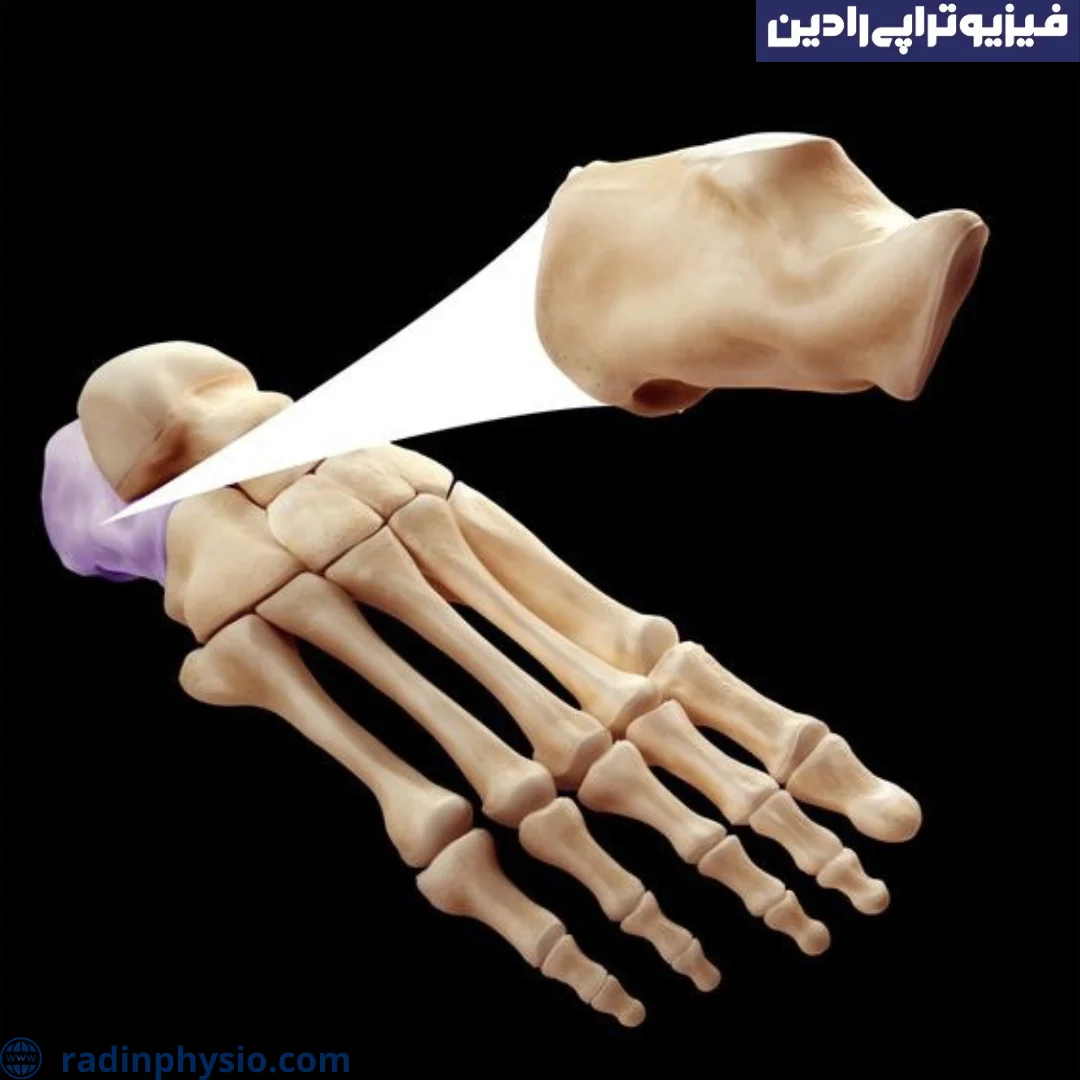 شکستگی پاشنه پا