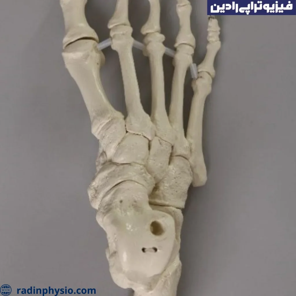 فیزیوتراپی برای درمان نوروم مورتون