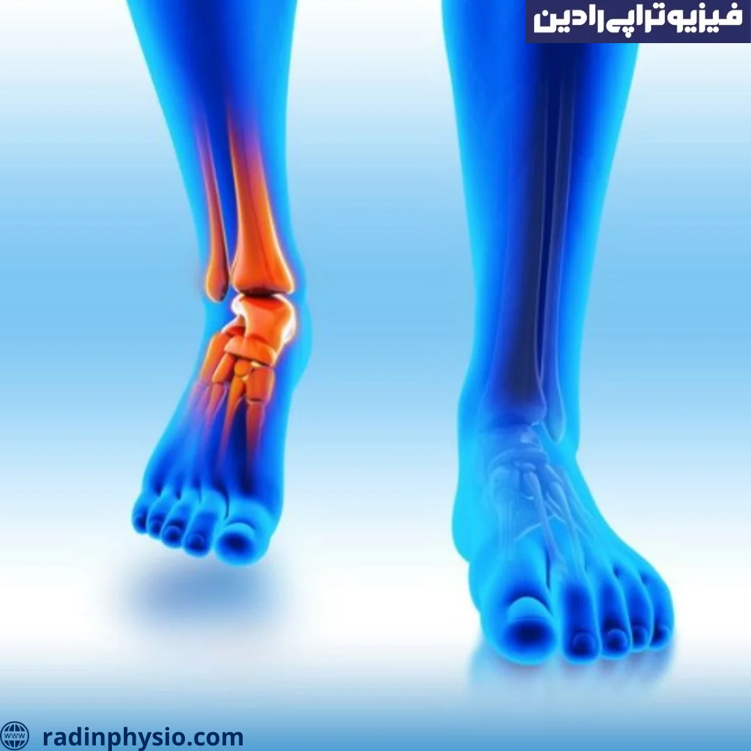 فیزیوتراپی التهاب تاندون پرونئال